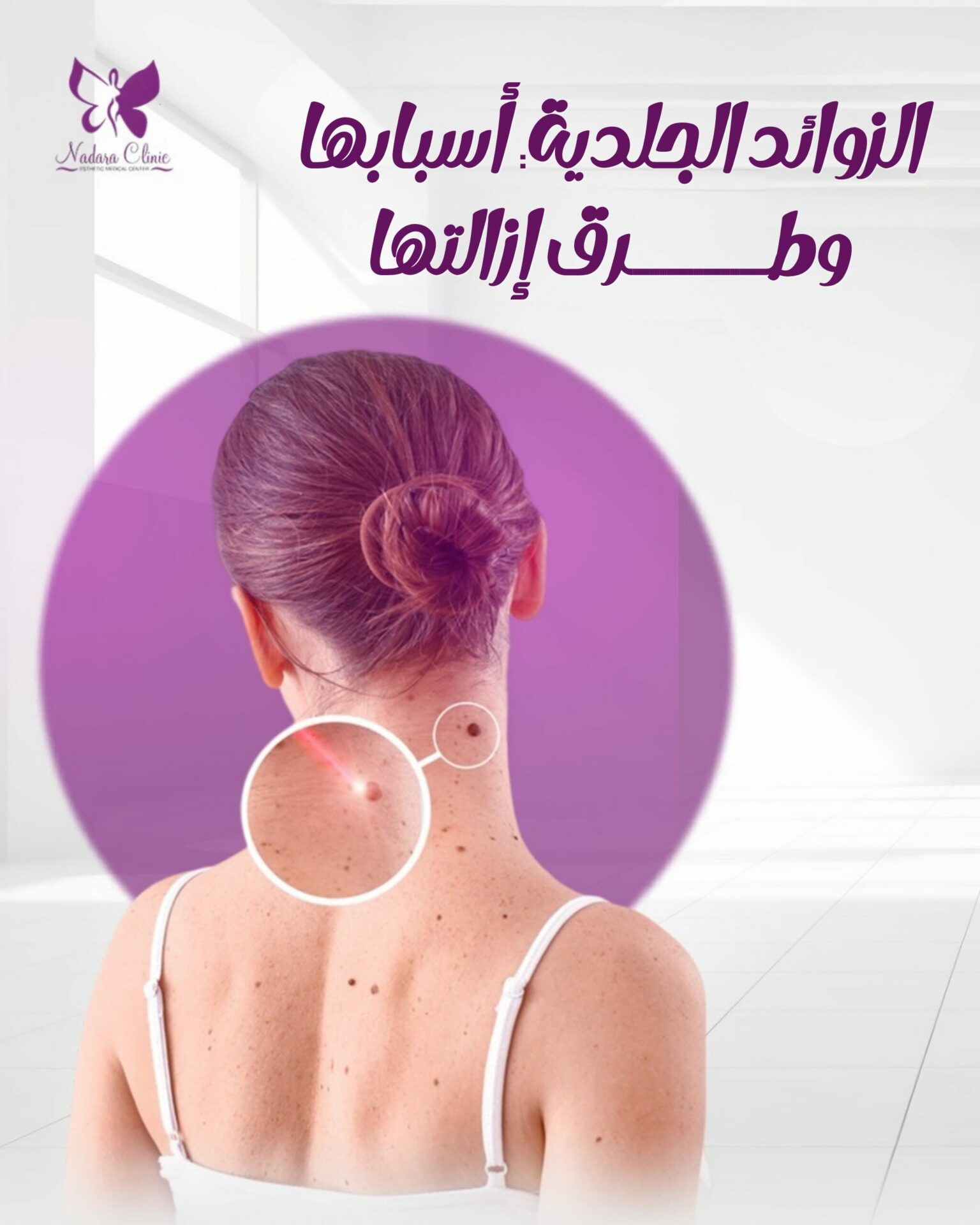 الزوائد الجلدية أسبابها وطرق إزالتها